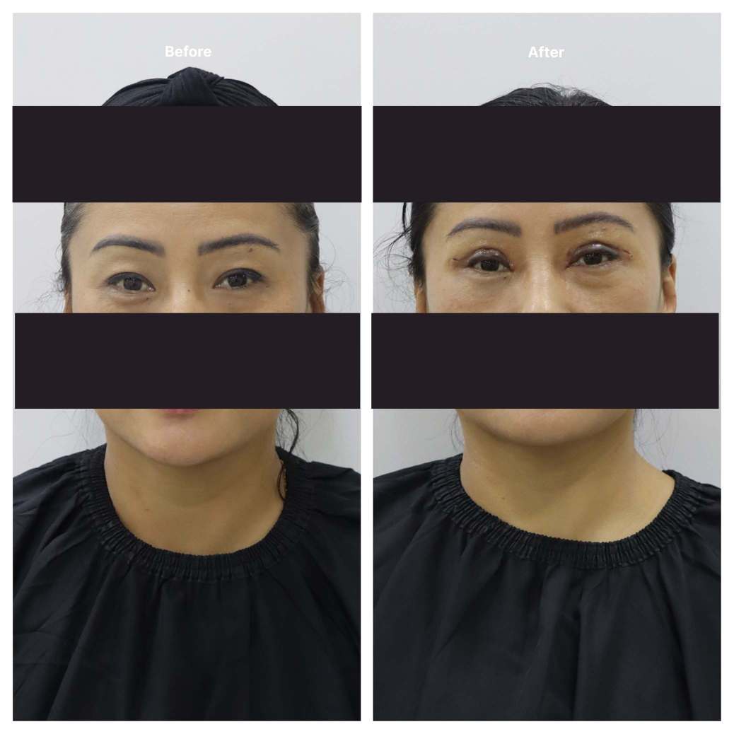 Eyelid Surgery KOQ10